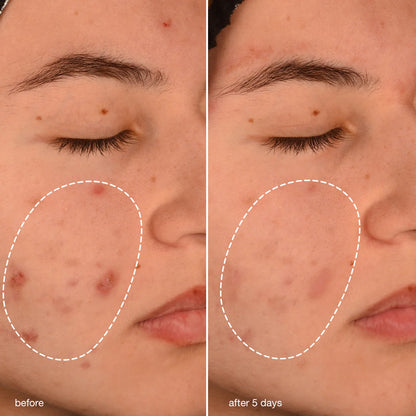 Breakout Biotic Moisturizer
